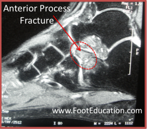 MRI Anterior Process Fracture of the Calcaneus