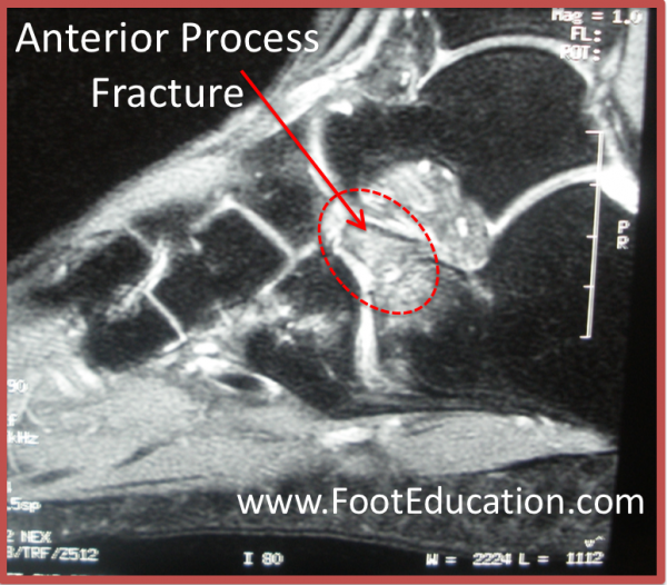 MRI of an Anterior Process Fracture of the Calcaneus