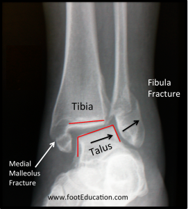 Plain X-Ray of an Unstable Ankle Fracture