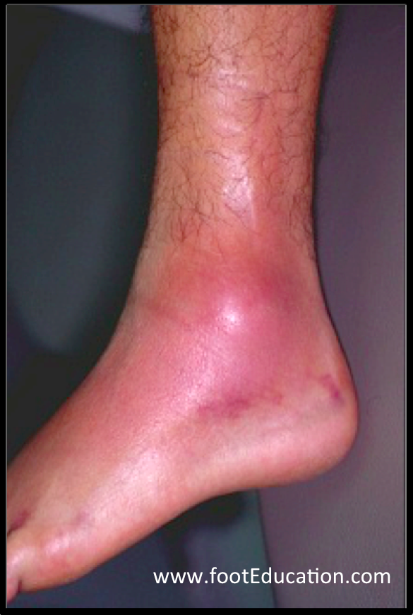 sprained-ankle-footeducation