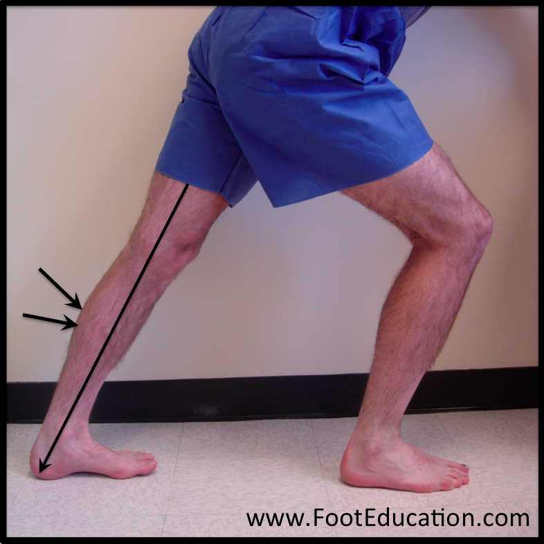 Equinus Contractures - FootEducation