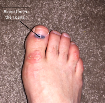 Subungal Hematoma, bleeding under the toenail