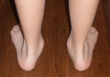 Flexible Flatfoot - Back View