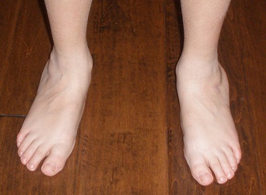 Flexible Flatfoot - Front View