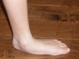Flexible Flatfoot - Side View
