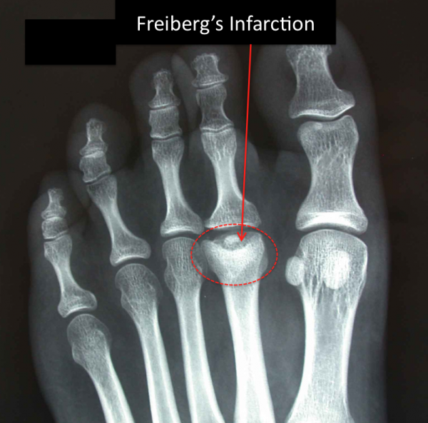 Freiberg's Infarction shown on x-ray