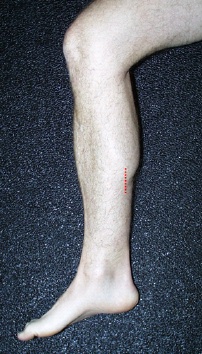 Gastrocnemius Slide - FootEducation