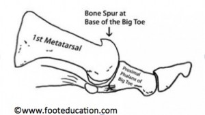 Great Toe Joint Bone Spur