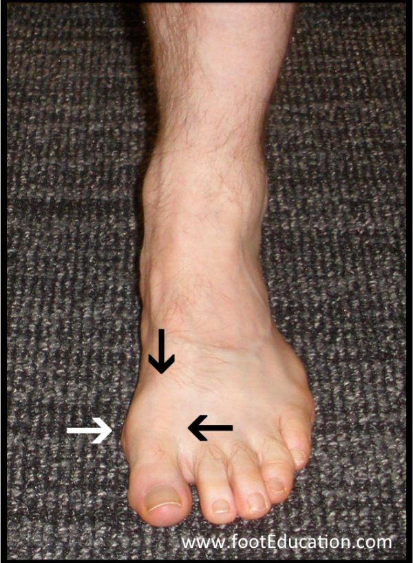 Hallux Rigidus Pain Location