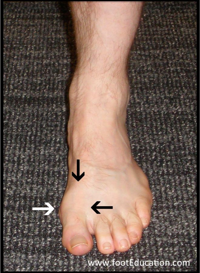 Hallux Rigidus (Big Toe Arthritis) FootEducation