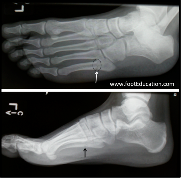 jones fracture treatment