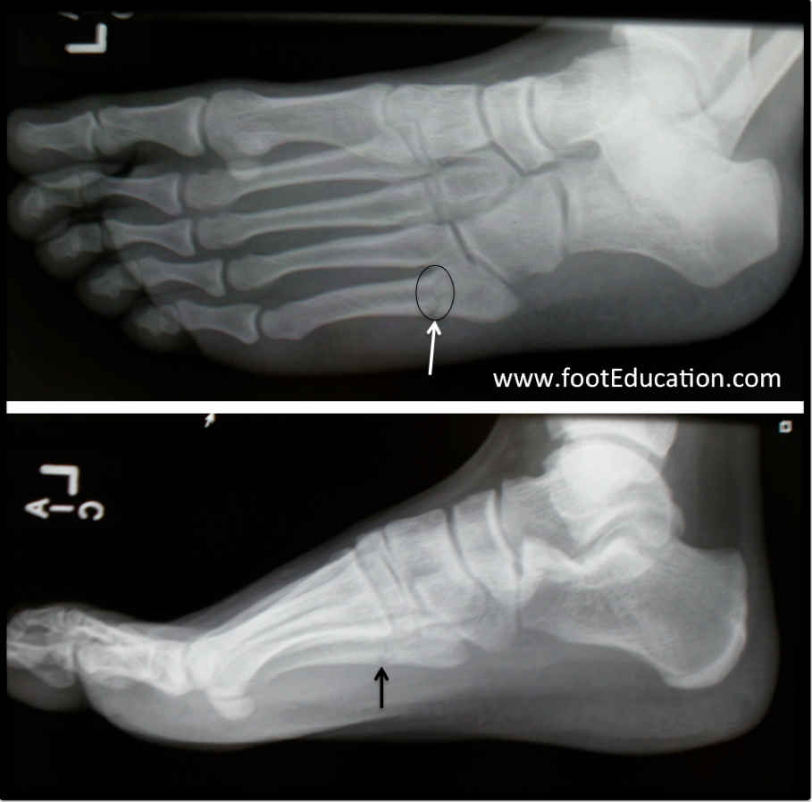 5th metatarsal fracture surgery