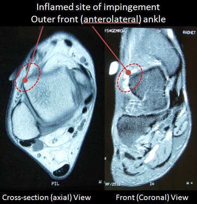 Anterolateral Ankle Impingement FootEducation