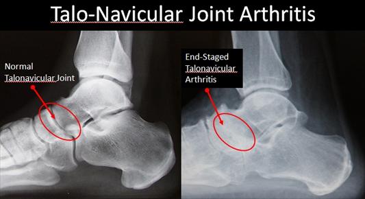 bone spur on navicular bone