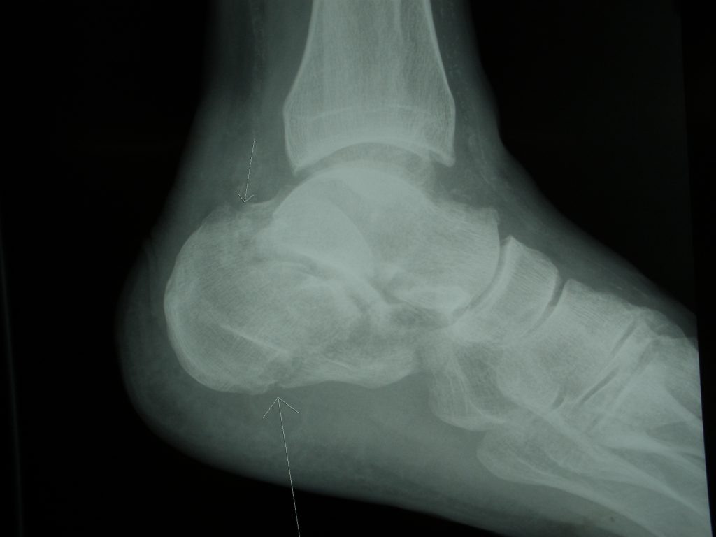 Calcaneus. Закрытый перелом пяточной кости. Перелом пяточной кости без смещения.