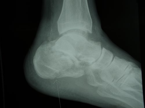 X-ray of fractured calcaneus from the side