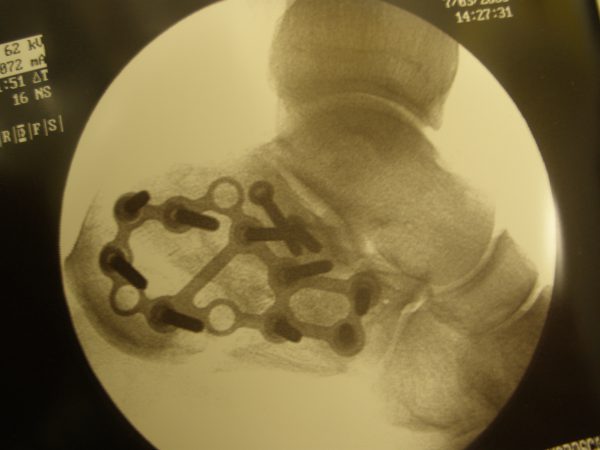 Calcaneus following surgical fixation