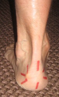 Insertional Achilles Tendonitis - FootEducation