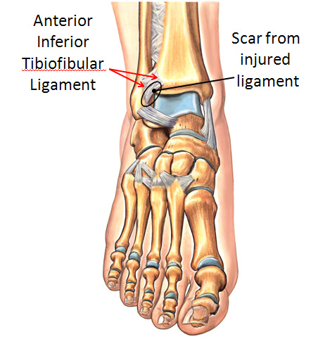 Scarred Anterior Inferior Tibiofibular Ligament
