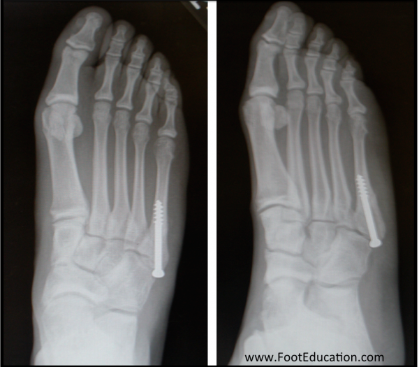 Screw Fixation of a Jones Fracture shown on x-ray