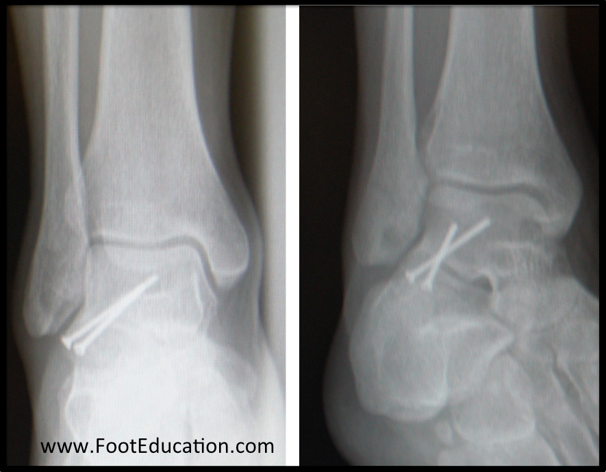 Lateral Talar Process Fractures FootEducation