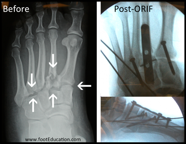 kirurgisk behandling av Lisfranc-skada