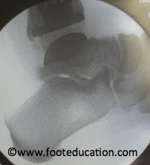 Tornier Salos Talaris Total Ankle Replacement