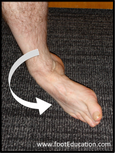 Twisting and loading mechanism that can lead to a 5th metatarsal shaft fracture also known as a dancer's fracture