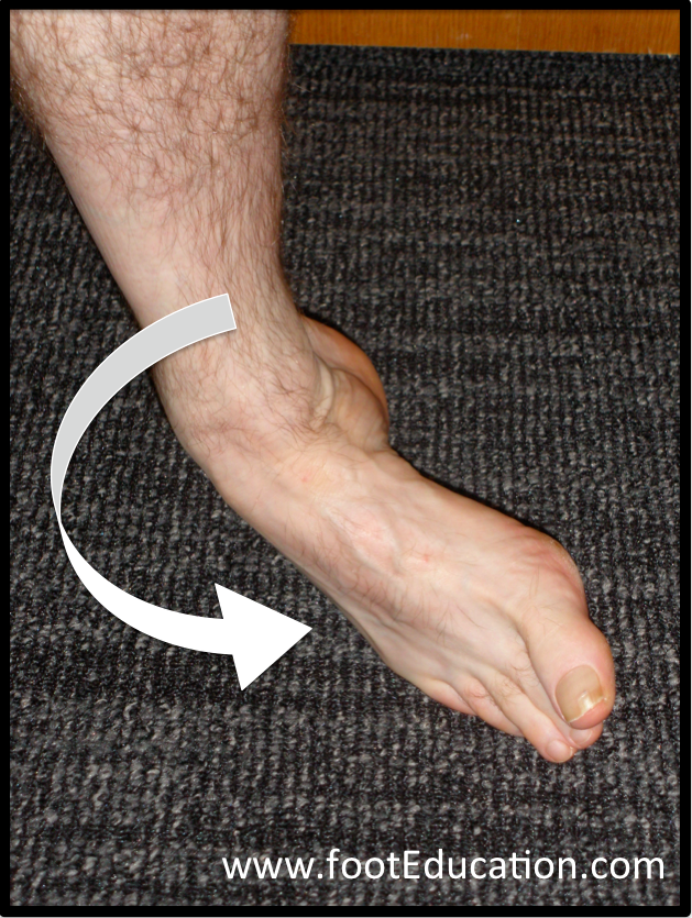 icd 10 code for left 5th metatarsal avulsion fracture
