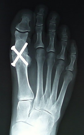 Typical Great Toe fusion with screws