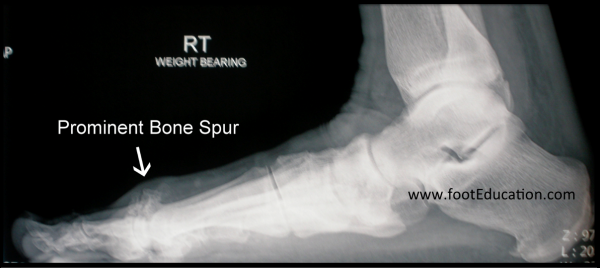 Weight-bearing x-rays showing Hallux Rigidus 2