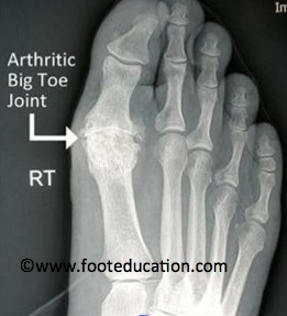 Weight-bearing x-rays showing Hallux Rigidus