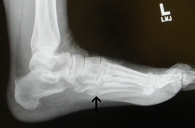 Dancers Fracture X-ray from the side