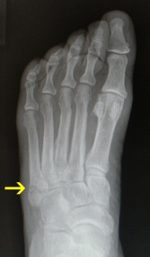 Dancers Fracture X-ray from the top