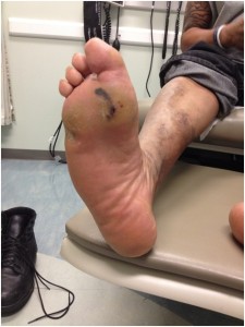 This patient is overloading the forefoot and has calluses, blood blistering, and ulceration