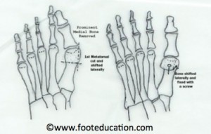 chevron osteotomy