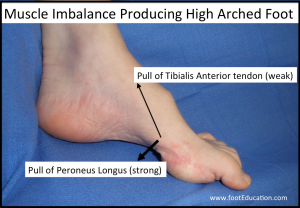 CMT Muscle imbalance producing arched foot