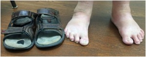 This patient is likely to get an ulcer at the tips of the right second and third toes