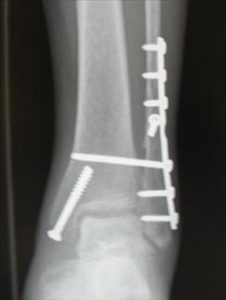 unstable ankle fracture stabilized with surgery