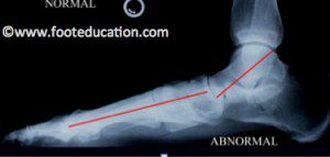 X-Ray of Flatfoot Deformity