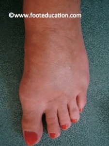 After SCARF Osteotomy Bunion Correction