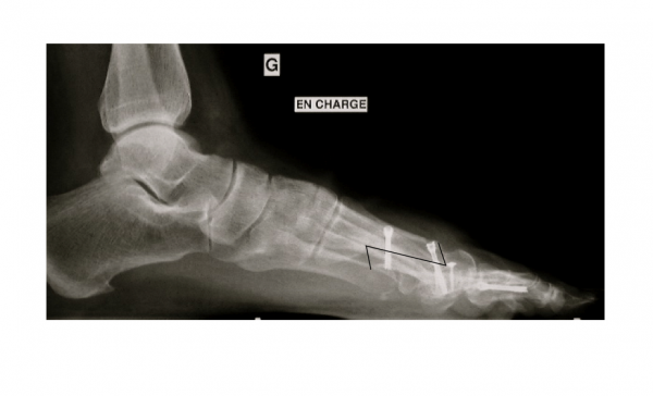 scarf-osteotomy-footeducation