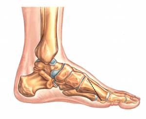 Ludloff Procedure - FootEducation