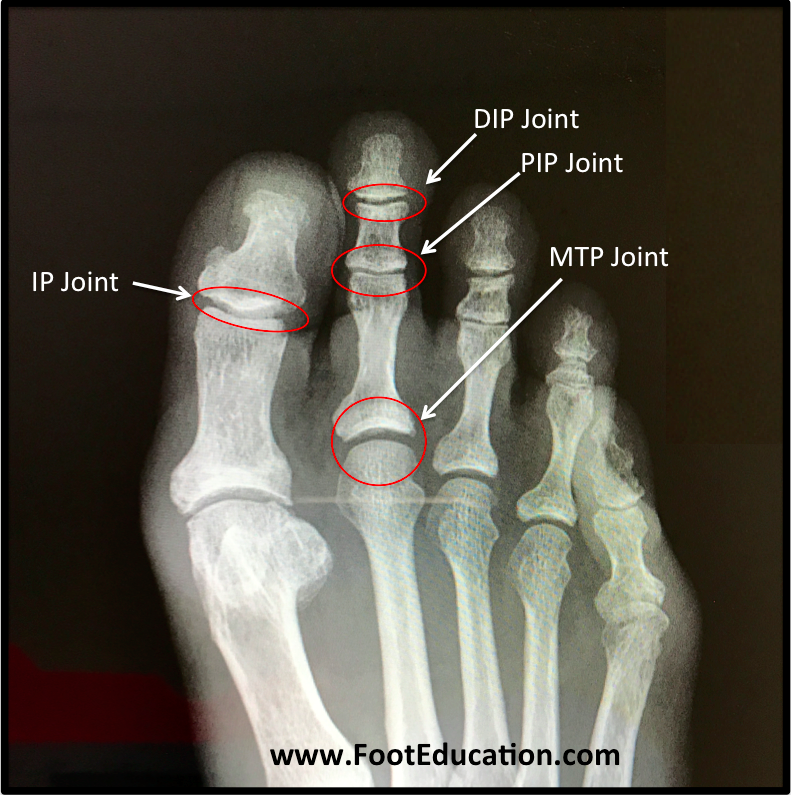 Middle And Distal Phalanges