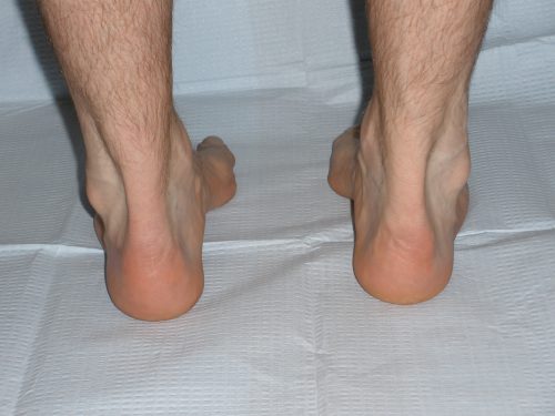 Characteristics of a High Arched Foot 