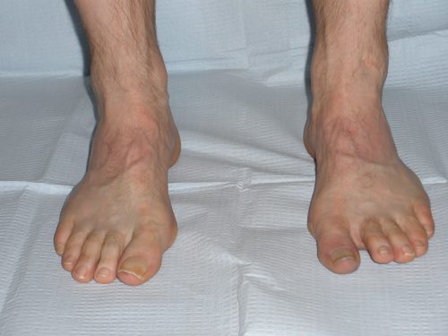 Anterior view of the foot showing the peek-a-boo sign in detail on