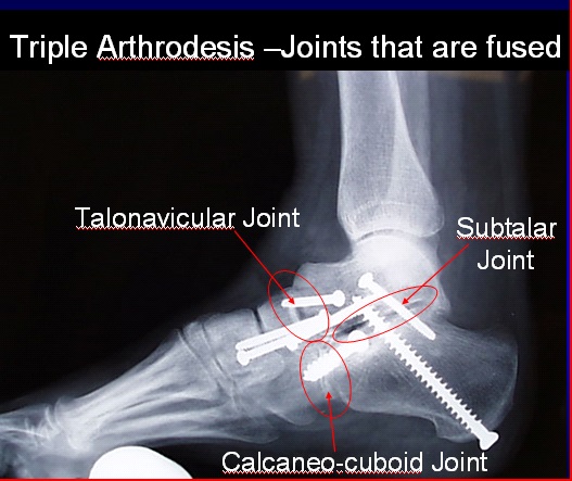 x ray hindfoot fusion