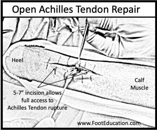 Open Achilles Tendon Repair diagram