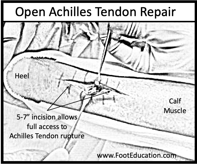 Achilles Tendon Repair Footeducation