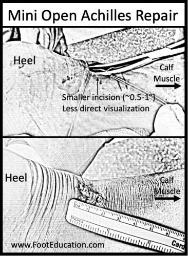 Mini Open Achilles Repair